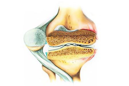 Arthritis of the knee