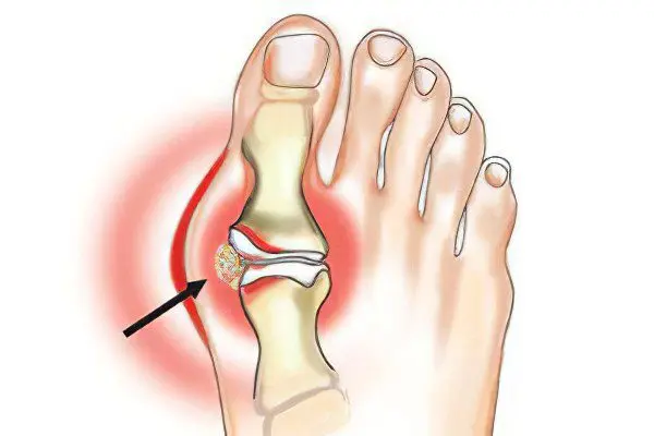 Arthritis of the toes