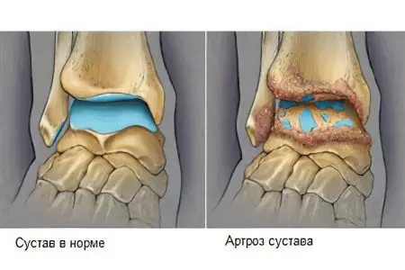 Arthrosis of the ankle joint: causes, symptoms, treatment