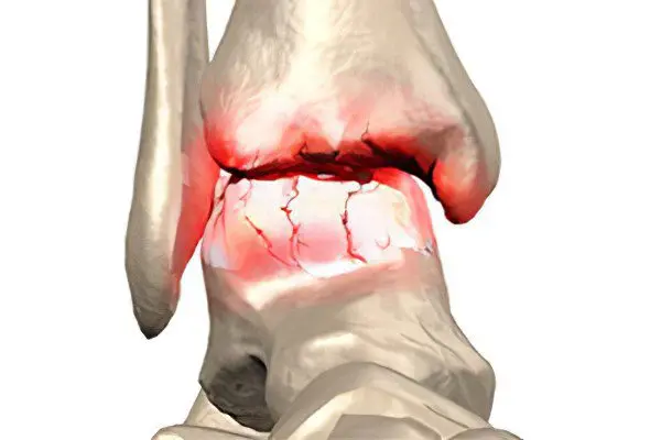 Arthrosis of the ankle joint: causes, symptoms, treatment