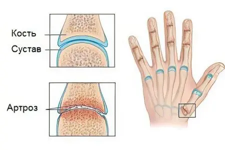 Arthrosis of the joints of the fingers and toes