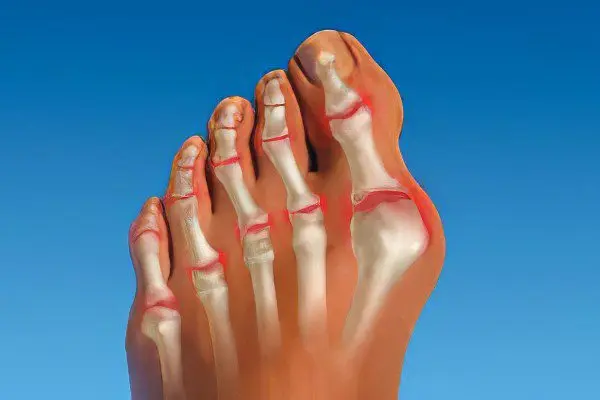 Arthrosis of the joints of the fingers and toes