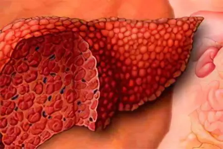 Ascites in cirrhosis of the liver