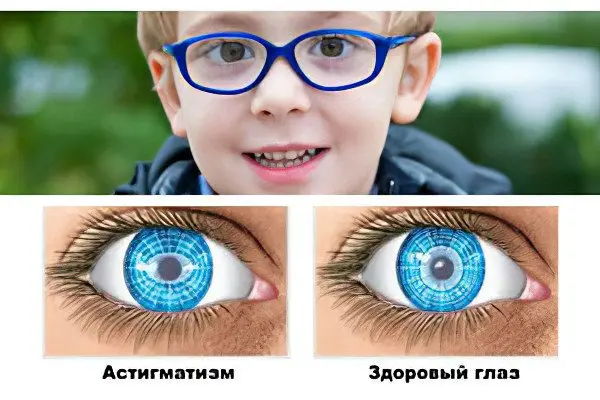 Astigmatism in children