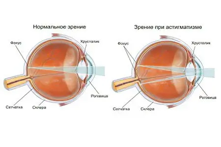 Astigmatism in children