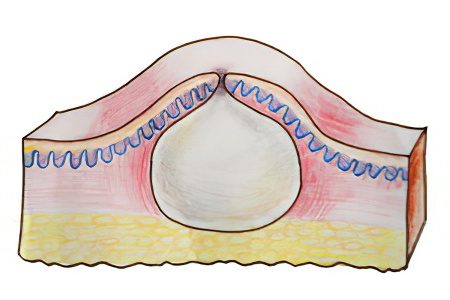 Atheroma on the face