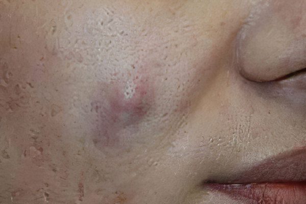 Atheroma on the face