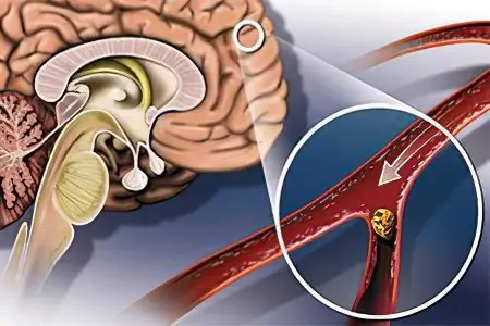 Atherosclerosis of cerebral vessels