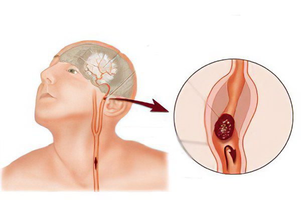 Atherosclerosis of cerebral vessels