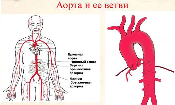 Atherosclerosis of the aorta of the heart