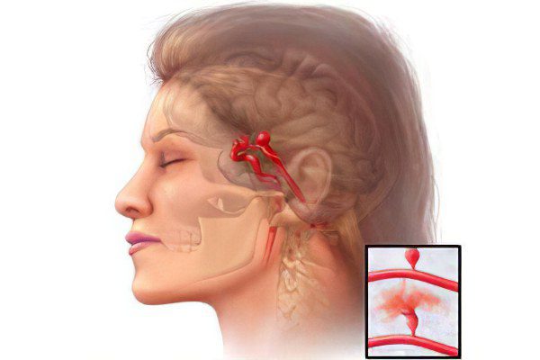 Atherosclerosis of the carotid arteries