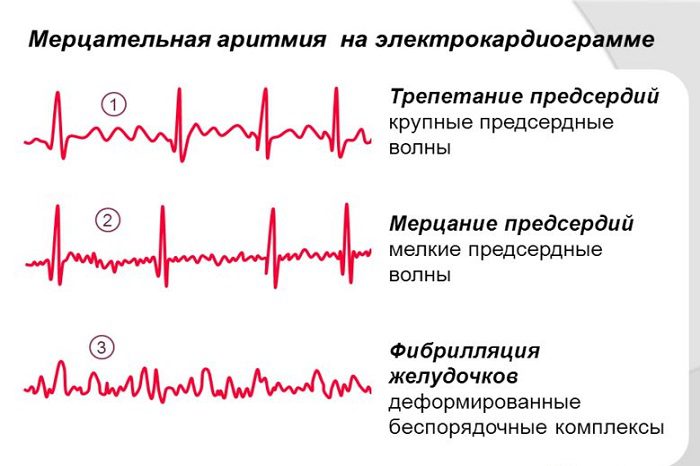 Atrial fibrillation: causes, symptoms and treatment