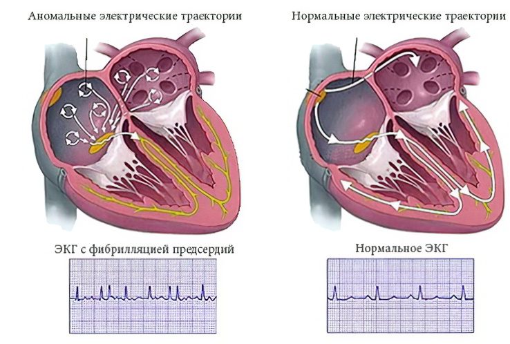 Atrial fibrillation: causes, symptoms and treatment