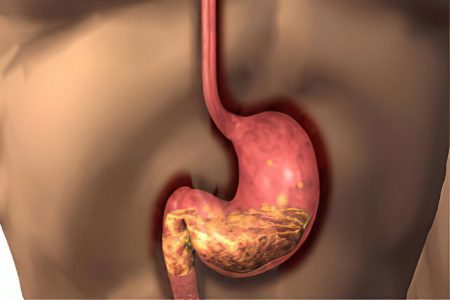 Atrophic gastroduodenitis