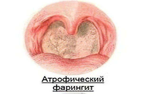 Atrophic pharyngitis