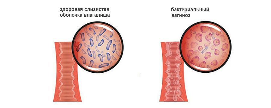 Bacterial vaginosis: causes, symptoms and treatment