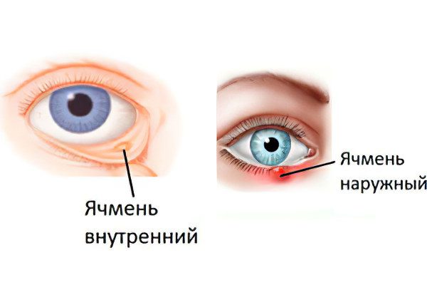 Ječmen na očesu: vzroki, simptomi in zdravljenje