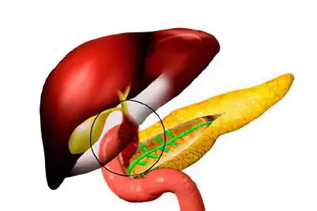 Biliary dyskinesia