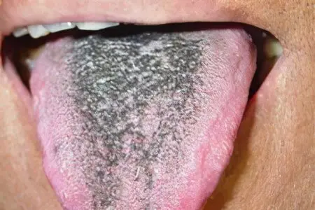 Black coating on the tongue