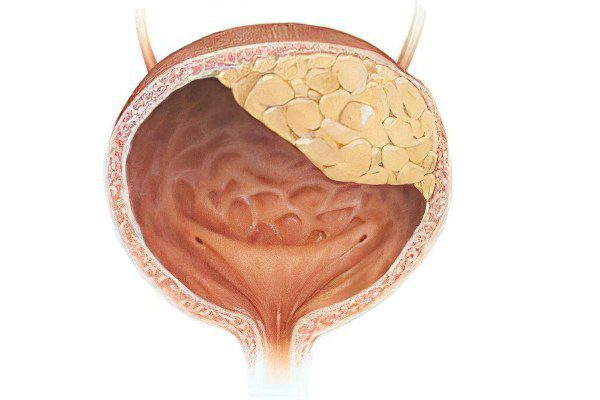 Bladder cancer in women and men