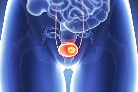 Bladder cancer in women and men