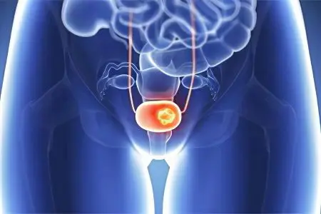 Bladder cancer in women and men