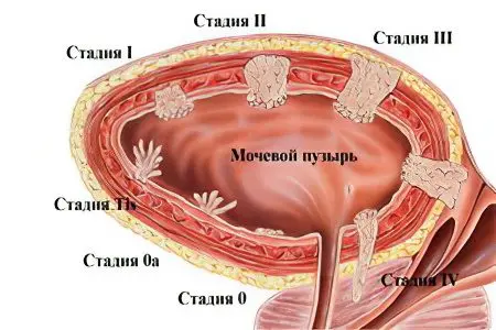 Bladder cancer in women and men