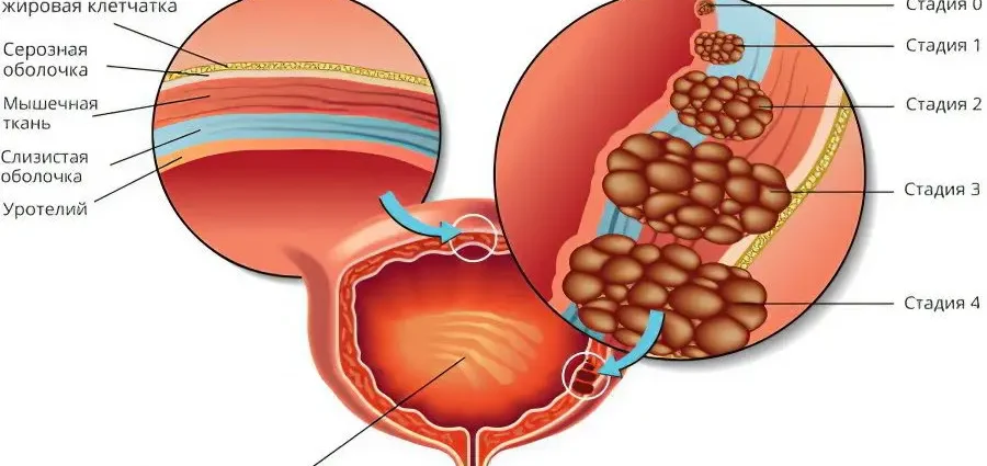 Bladder leukoplakia: symptoms and treatment