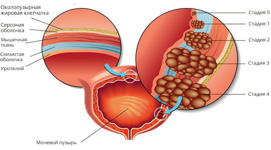 Bladder leukoplakia: symptoms and treatment