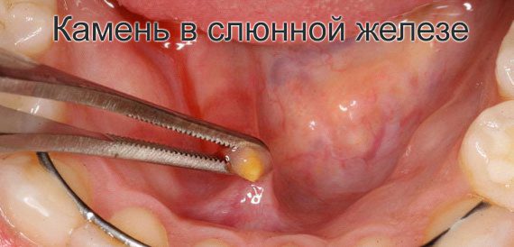 Blockage of the salivary gland, treatment