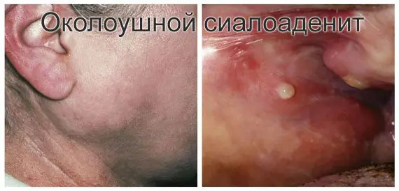 Blockage of the salivary gland, treatment Blockage of the salivary gland, treatment