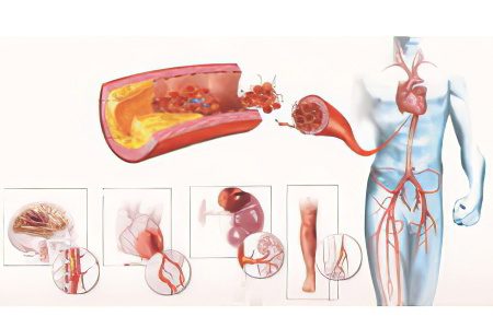 Blood clot in the heart: symptoms and treatment