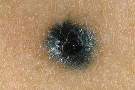 blue nevus