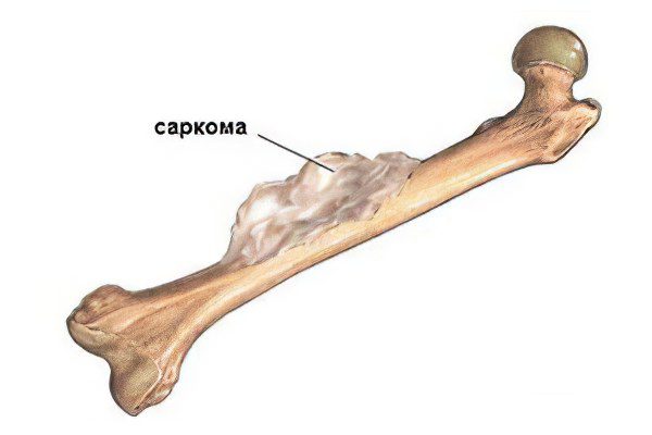 Bone sarcoma