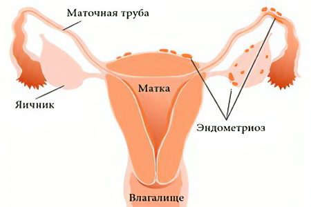 Boron uterus with infertility