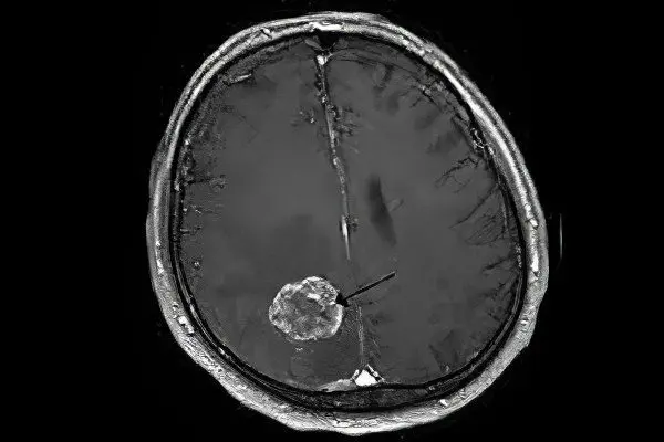 Brain sarcoma