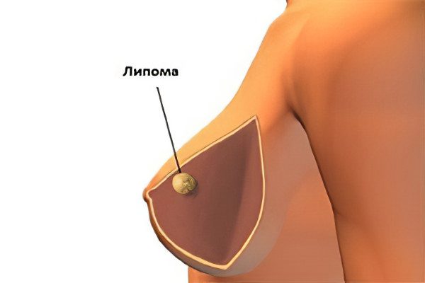 Breast lipoma