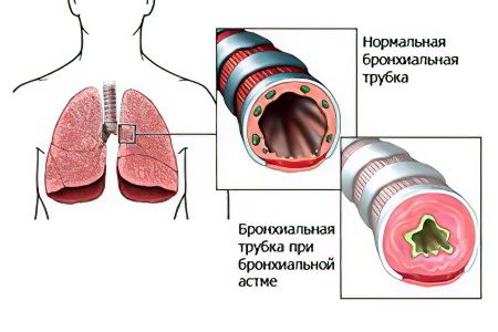 Bronchial asthma: first signs and symptoms, causes and treatment