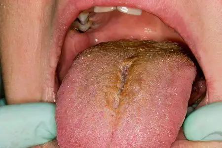 Brown coating on the tongue