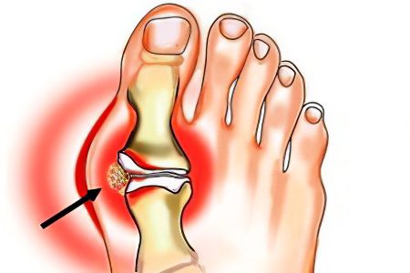 Bumps on the legs at the big toe: causes and treatment