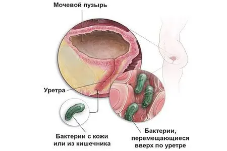 Burning and pain during urination in women and men