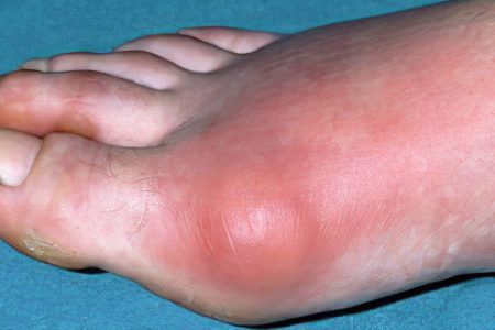 Bursitis of the big toe