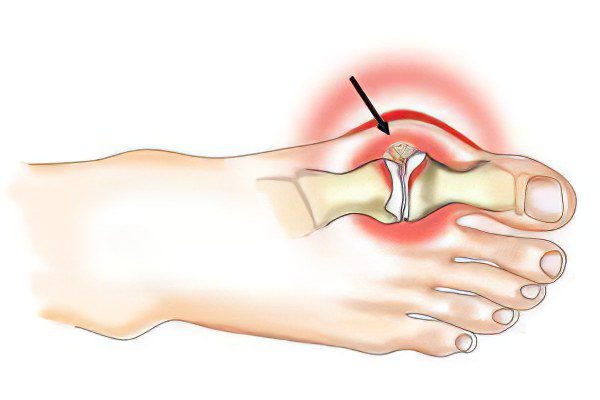 Bursitis of the big toe