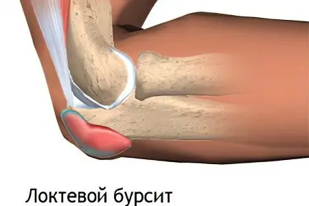 Bursitis of the elbow joint