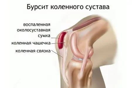 Bursitis of the knee