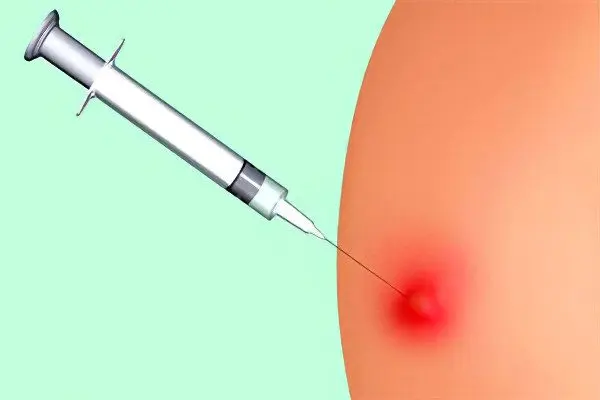 Buttock abscess after injection