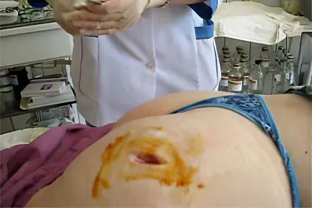 Buttock abscess after injection