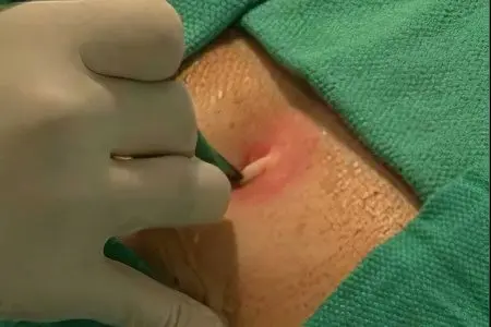 Buttock abscess after injection