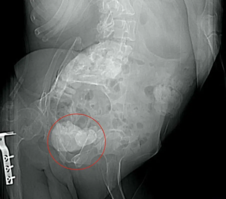 Calcifications in the prostate