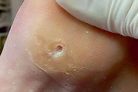 Callus - causes and methods of treatment